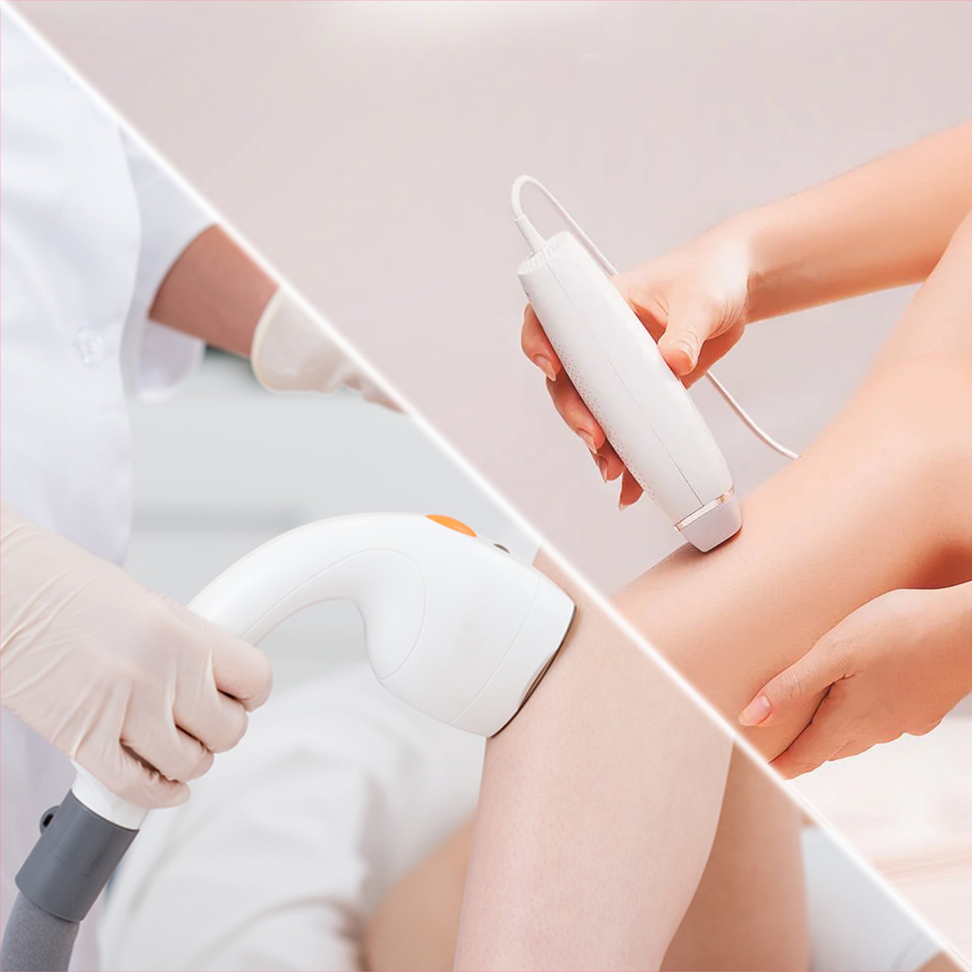 AtHome Laser Hair Removal vs. Professional Which is Better? Koizuma®